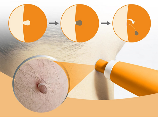 Kit pour acrochordons