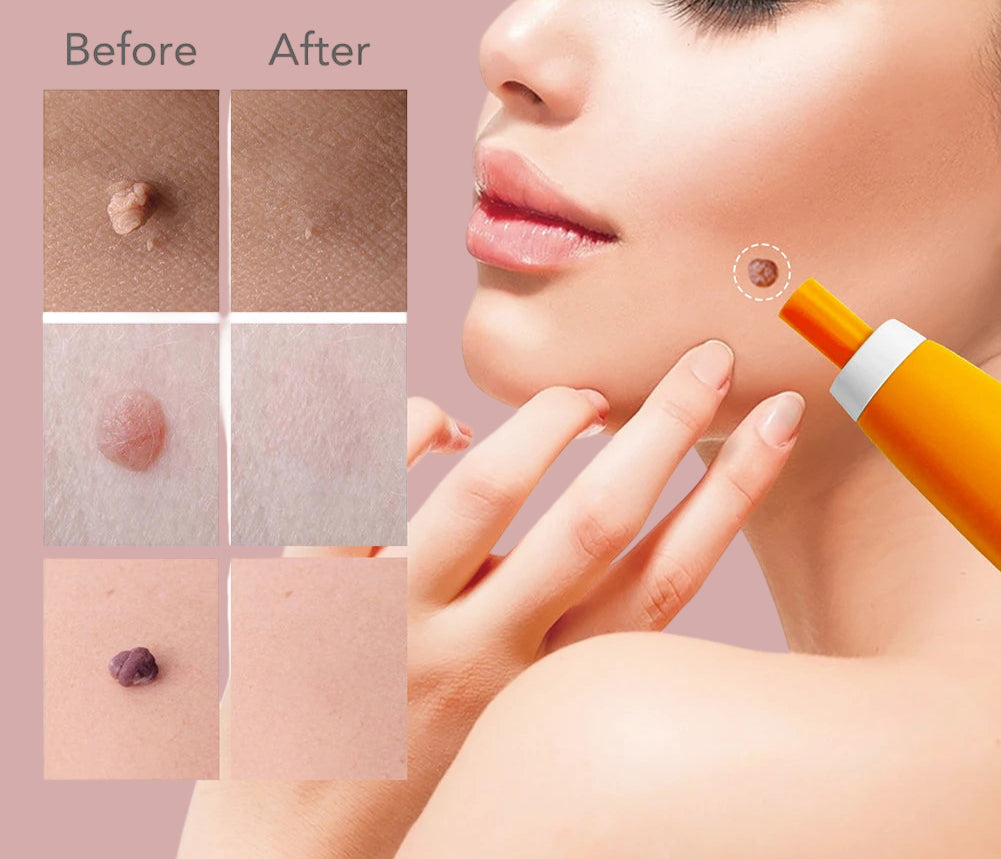 Kit pour acrochordons